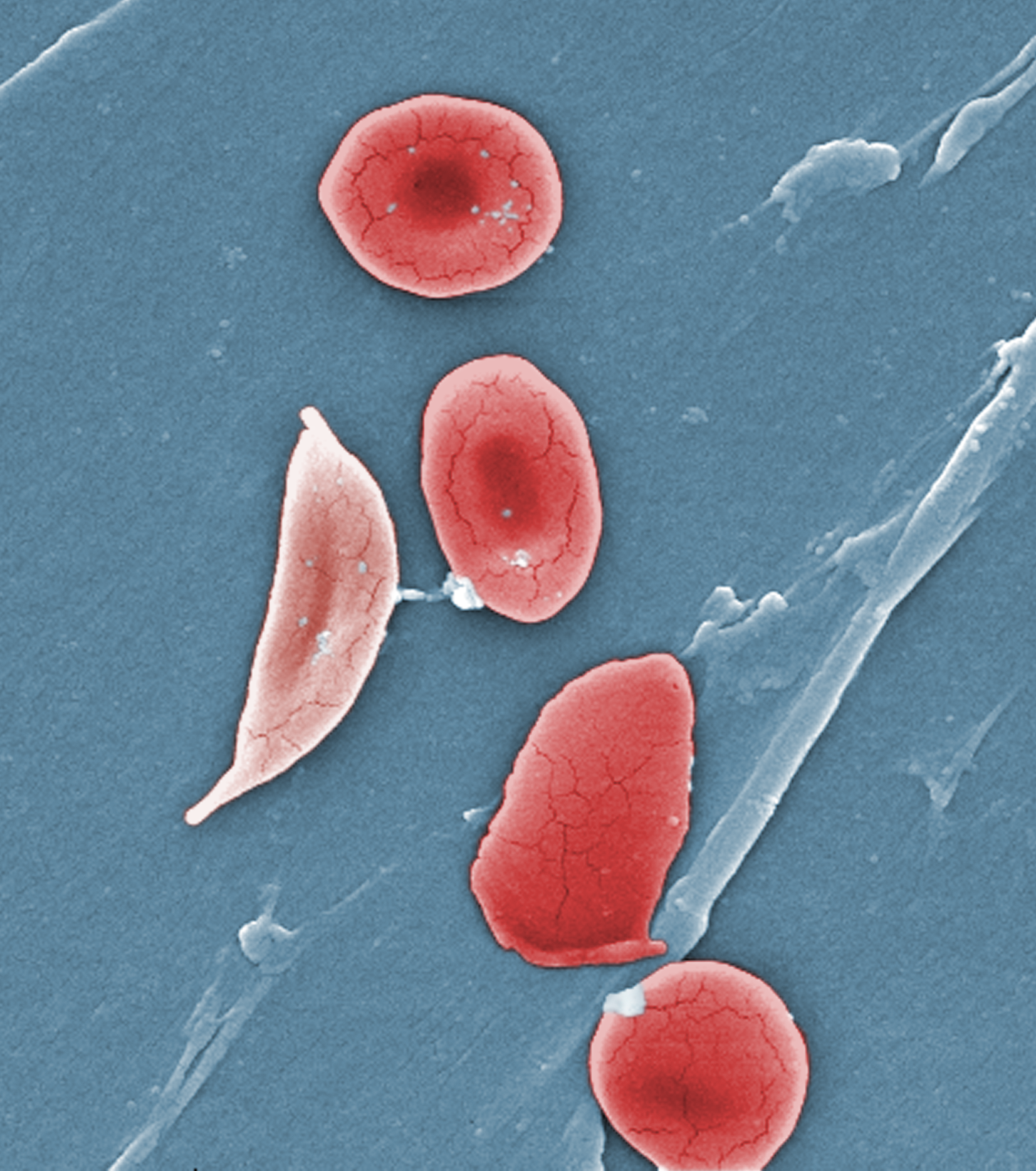 Slow Progress Towards Treatment Of Sickle Cell Anemia ScienceWriters 