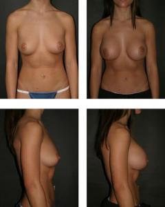 Bilateral saline breast implants, before (l) and after. Credit: Otto J. Placik